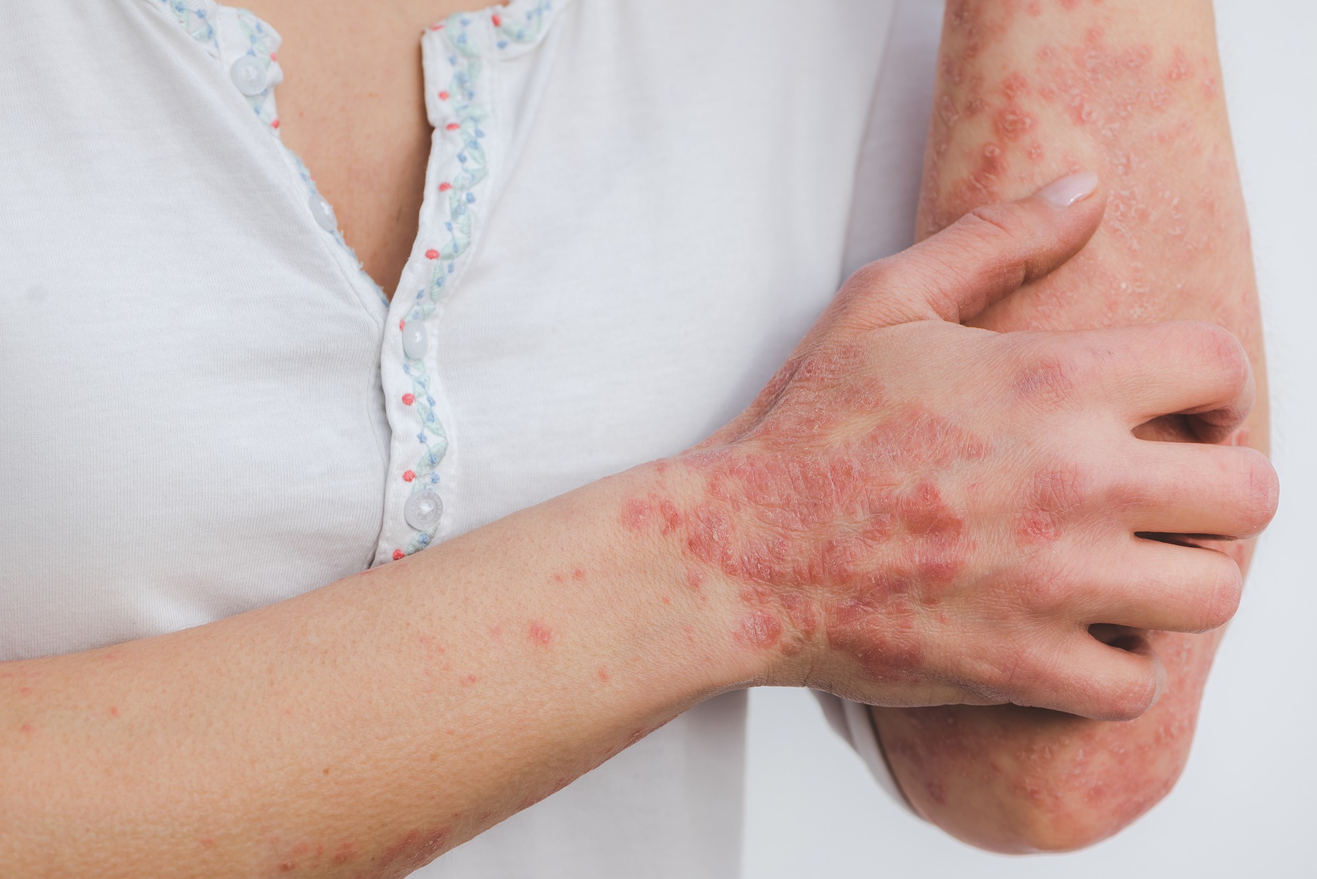 Psoriasis-behandling