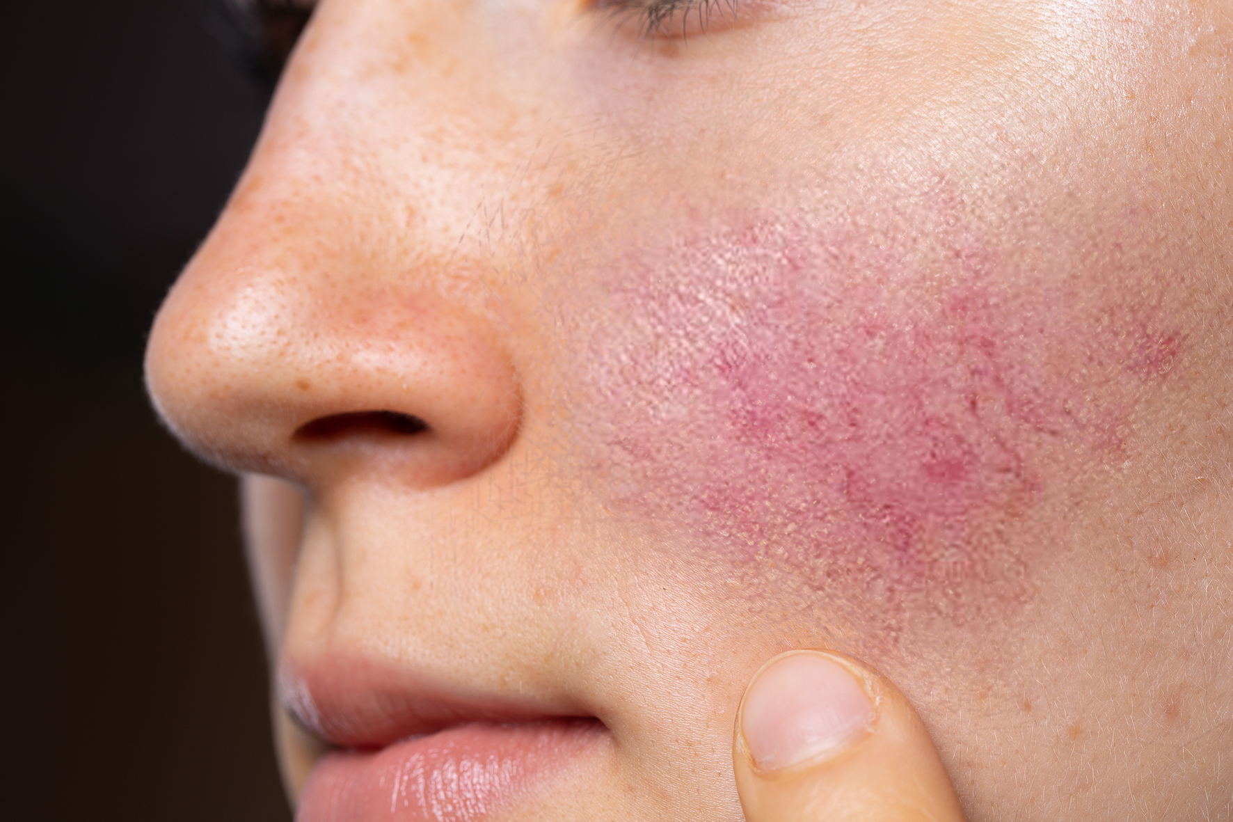 rosacea.jpg